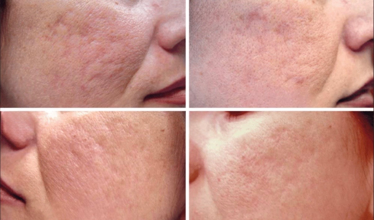 משחה לצלקות