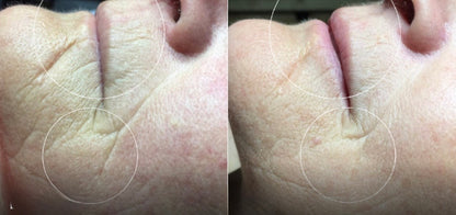 משחה לצלקות