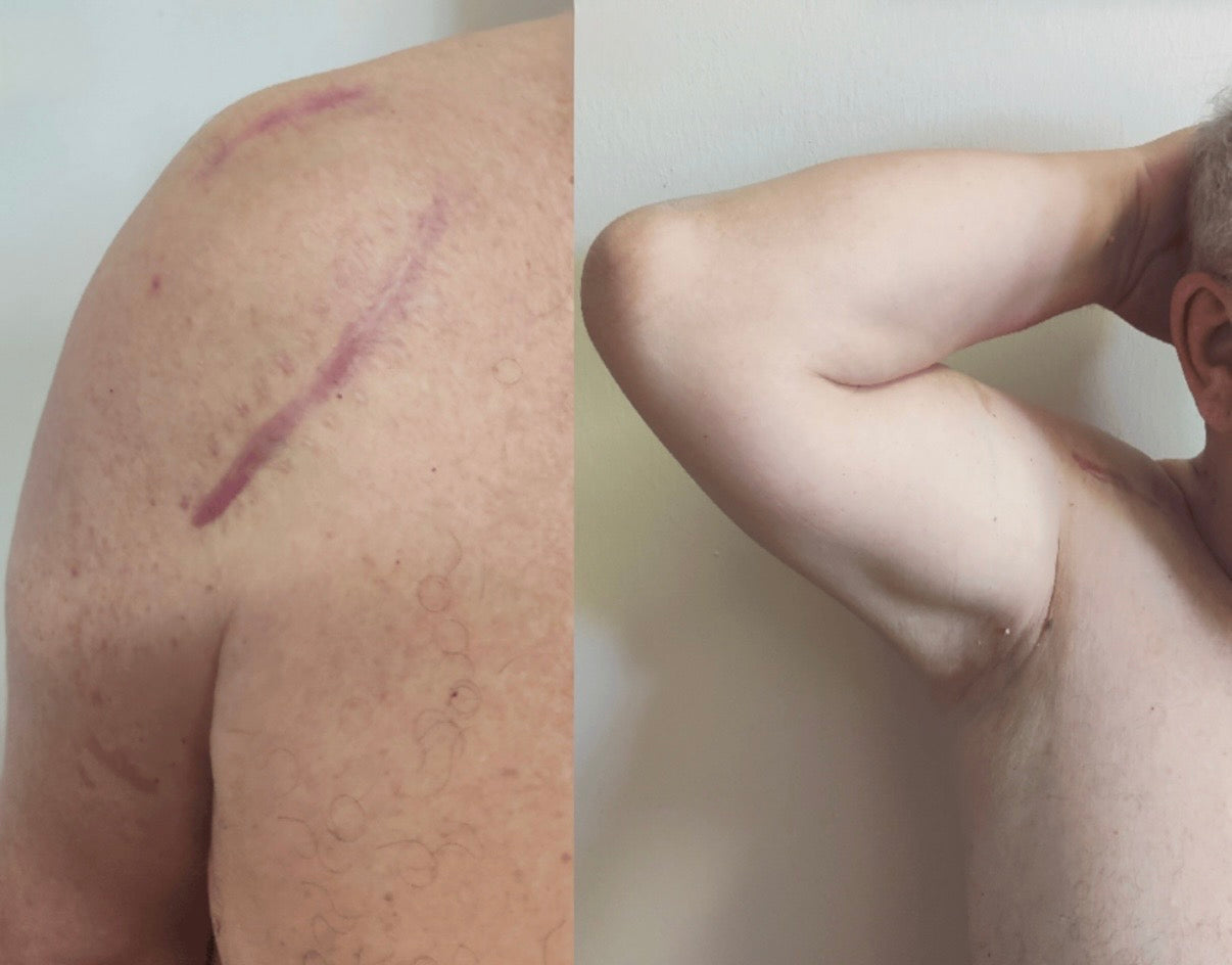 משחה לצלקות