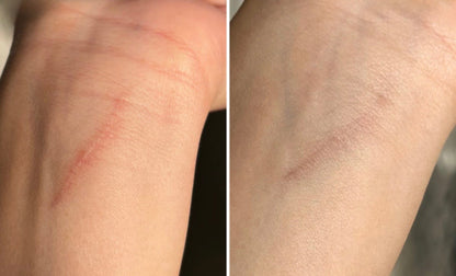 משחה לצלקות